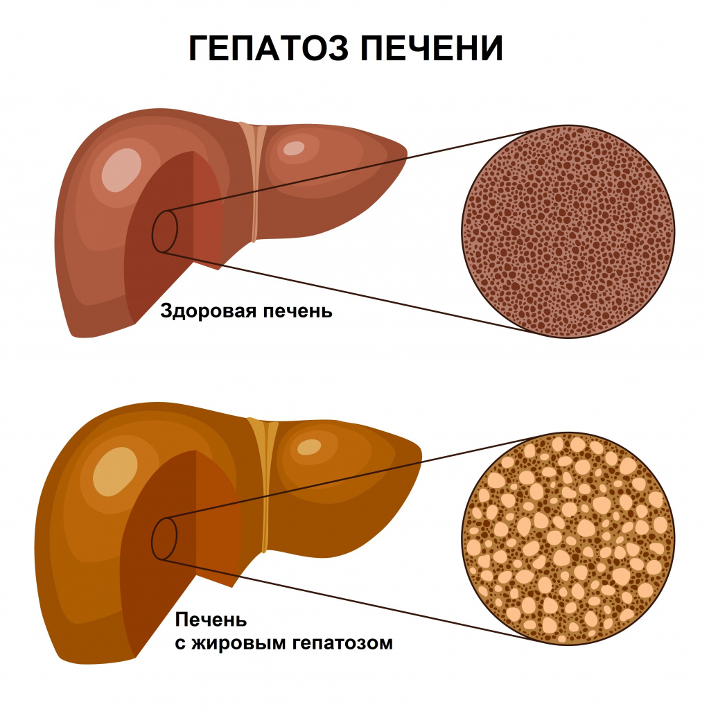 признаки гепатоза печени